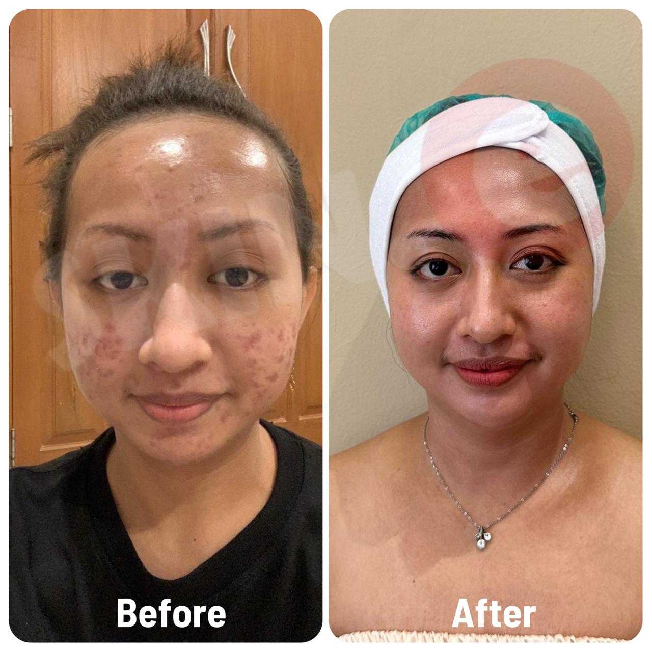 Acne Treatment (Include Acnelite)